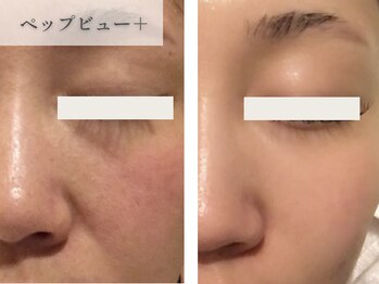 南青山コスメクリニック スキンラボ 新宿(SKIN LAB)/ペップビュー