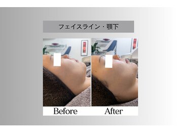 フェイシャルサロン セレスタイト/これがBHF　ダウンタイムなし