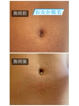 プレジール(PLAISIR)/20代男性　おなか脱毛