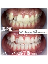 ホワイトニングサロン 京都烏丸店/ホワイトニング施術例　