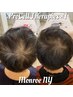 【プロセル頭皮改善トリートメント】ヒト骨髄幹細胞を導入☆育毛を促進◎