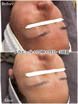 バブルビューティー(Bubble beauty)/ララピール・LDM・LED