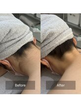 凰湖/うなじ脱毛