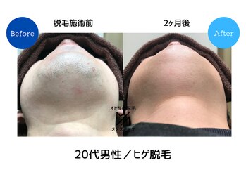 メンズアメリ/高知/メンズ脱毛/ヒゲ/全身/VIO