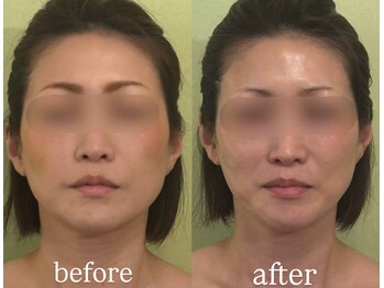 サロンハート(Salon Heart)/