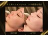 【シワ改善＆美白ツヤ肌】次世代ピーリング★ラミネーションピール￥9,990