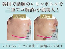 レモンボトルでフェイスラインすっきり小顔ケア！