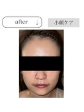 アイチューズ(ICHOOSE)/たった1回でこの引き締まり！