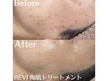 ホワイトアクア 中目黒店(WHITE AQUA)/ハーブピーリング/ニキビケア