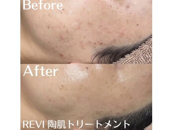 ホワイトアクア 中目黒店(WHITE AQUA)/ハーブピーリング/ニキビケア