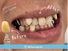 ホワイトニングカフェ 豊中店(WhiteningCafe)/◎歯のホワイトニング施術写真◎