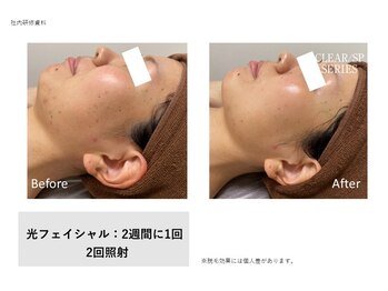 フェレザ 新潟(Felleza)/光フェイシャル女性スタッフ施術