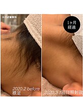 スパ イグレック パリ 小竹向原店(SPA IGREK PARIS)/キッズ◆えりあし脱毛