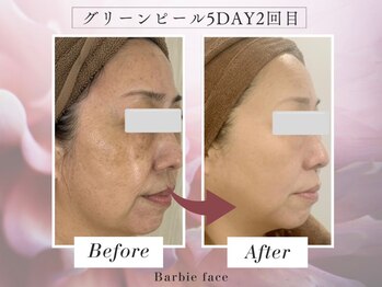 バービーフェイス 恵比寿(Barbie Face)/グリーンピール5DAYS 2回目