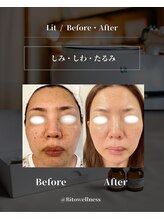 ビトウェルネス 池尻大橋(Bi to wellness)/【シミしわたるみ】肌育成