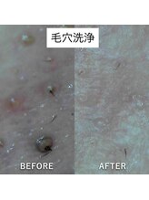 ヴィヴ 三島店(Vive)/《毛穴洗浄》