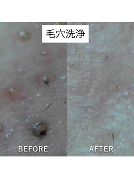 ヴィヴ 三島店(Vive)/《毛穴洗浄》