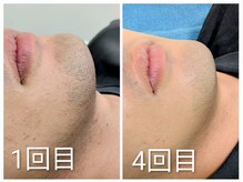 トータルビューティー マシロ(mashiro)の雰囲気（メンズ脱毛も可！パックや美容液等のアフターケア付き☆）