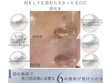 毛穴研究所の雰囲気(毛穴詰まりや開き毛穴の原因へ-6つの工程で毛穴を整えます)