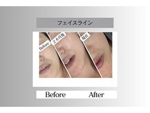 フェイシャルサロン セレスタイト/「たるみ」だけでなくシワまで