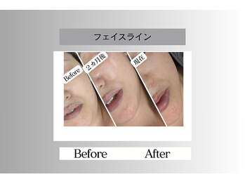 フェイシャルサロン セレスタイト/「たるみ」だけでなくシワまで