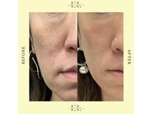 ジルフィー(GILFY)/たるみ/ほうれい線解消☆