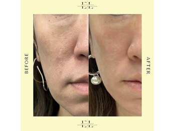 ジルフィー(GILFY)/たるみ/ほうれい線解消☆