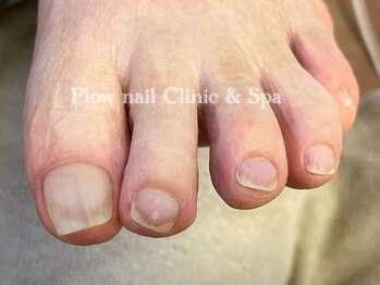 プラウネイル(Plow Nail)/【トラブルネイル】巻き爪・ケア