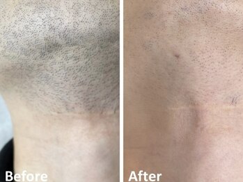 ルミネル 名古屋新栄(Luminelle)/髭