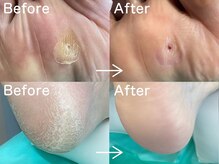 ディオフット(DIO FOOT)の雰囲気（巻き爪/陥入爪/肥厚爪/魚の目/タコ...痛みを解消）