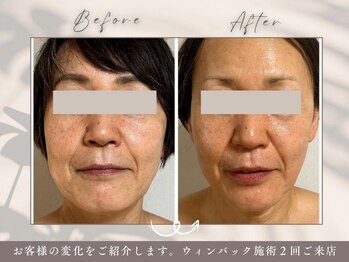 碧(ao)/WINBACK2回の効果！