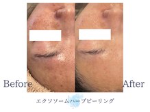 ディアスマイル(Dear.smile)/エクソソームハーブピーリング