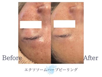 ディアスマイル(Dear.smile)/エクソソームハーブピーリング