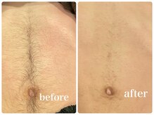 エリクサー 加須店(Elixir)/照射1回で伸びるのが遅くなる！