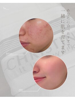 シャルム(Charme)の写真/何をしても変わらなかったあなたへ。
あなたに合う肌ケアをご提案します