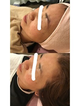 施術所ひびき庵/エステで肌質改善