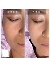 サロン ド パーフェクション(Salon de Perfection)/ヒト歯髄幹細胞　無針水光導入