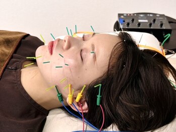 フラット(flat)の写真/電気を流す美容鍼【小顔美容鍼¥4980】1回の施術でこんなに変わる?!むくみ/小顔効果だけでなく夏バテにも◎