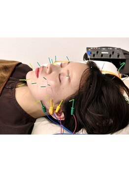 鍼灸施術を受けたい