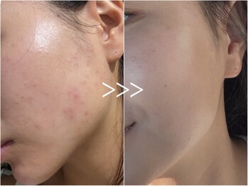 フィー(Fee)/松ヤニの殺菌効果で脱ニキビ!