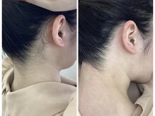 エレーナ 虎ノ門(Elena)/うなじ　顔　脱毛　ワックス　光