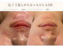 エステティックサロン シーズ/Qくり返しがちなニキビにもOK？