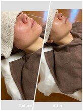 すーりーる/赤みを落ち着かせ…