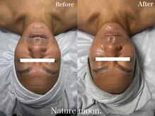 ナチュールムーン(Nature moon.)/ハーブピーリング