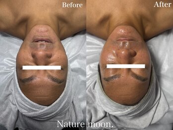 ナチュールムーン(Nature moon.)/ハーブピーリング