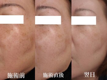 ナーズ(NAZ)/光フェイシャル