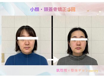 メリー 大和西大寺店(merry)/小顔・頭蓋骨矯正Before after★
