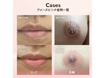 オアシス 一宮(Oasis)の写真/《新登場》韓国で話題の最新技術！AMAZE PINKで気になる黒ずみ・くすみをトーンアップケア♪