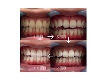 ホワイトニングショップ 大阪玉造店/元の歯と見間違える程の白さに