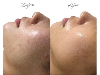 ビズビズ 梅田店(bisebise)/梅田ハーブピーリング/ニキビ